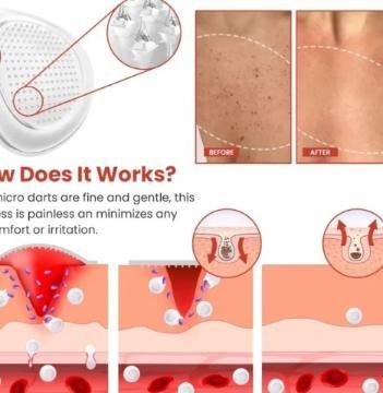 Skin Tag Remover Patch | 🔥Flat 50% Off Sale🔥